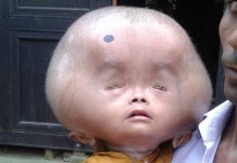 शरीरको तौलबराबर टाउको भएको बच्चा