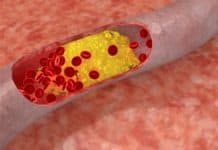 कोलेस्टेरोल बढेको कसरी थाहा पाउने ?