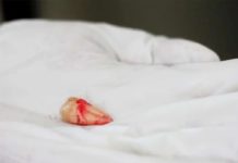 नाकमा दाँत पलाएपछि सबै आश्चर्यचकित