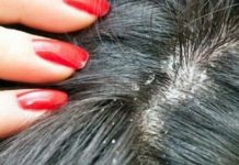 चाया हटाउने घरेलु उपाय :