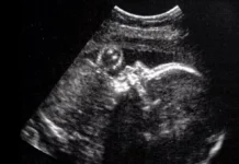 डाक्टरले गर्भमा हुर्किरहेको भ्रूणको शल्यक्रिया गरे