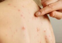 ६२ जना विद्यार्थीमा दादुराकाे लक्षण