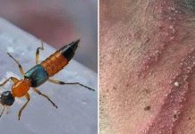 नाइराेबी फ्लाइबाट बच्ने उपायहरु