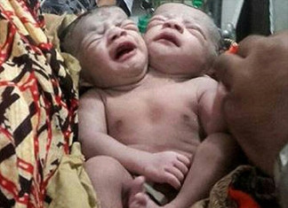 दुई टाउको भएकी बालिका
