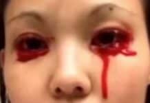 आँखाबाट रगतको आँशु निस्कने महिला !