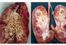 मानिसको सामान्य लापरवाही किड्नी खराब हुनुको मुख्य कारण,आफ्नो किड्नी यसरी जोगाउनुहोस्