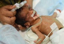 58,000 children die every year in India due to antibiotic resistance : report
