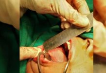 बन्द भएको मुखको सफलता पूर्वक शल्यक्रिया