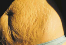 गर्भवती अवस्थामा छाला च्यातिएर बसेको दाग हटाउने उपायहरु