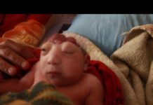 झापाको दमकमा जन्मियो तालु नभएको बच्चा