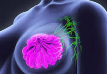 यस्ता छन्- स्तन क्यान्सरका लक्षण र कारणहरु