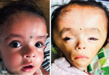 नौ महिनामा पाँचपटक टाउकोको शल्यक्रियापछि बालकको यस्तो हालत