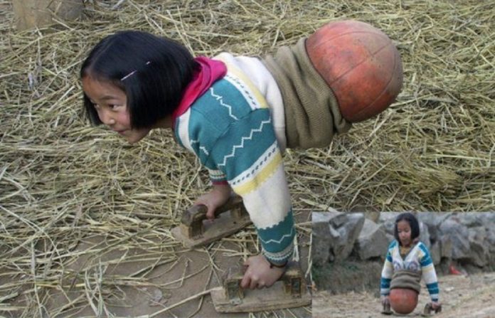 Legless-basketball-champion