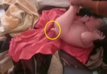 पुच्छरसहित अनाैठाे शिशुकाे जन्म