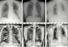 काेराेना संक्रमित पश्चात फोक्सोमा देखिने खराबी पत्ता लगाउन नयाँ प्रविधिको विकास