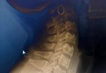 नेपालका डाक्टर खाना नलीमा अड्किएको हड्डी निकाल्न सफल भए