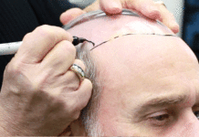 कपाल प्रत्यारोपणको बढ्दो क्रेज