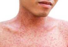 सुर्खेतमा पाँच जनामा दादुरा सङ्क्रमण पुष्टि