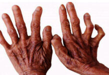 देशभर विभिन्न कार्यक्रमका साथ विश्व कुष्ठरोग दिवस मनाइँदै