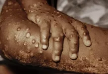 मंकीपक्स स्वीडेनमा फेला