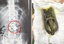 बालकको पेटबाट चिकित्सकले कैंची निकाले !